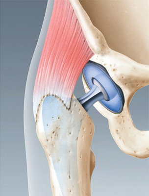 hirslanden-revision-von-kuenstlichen-hueftgelenken-3
