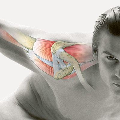 hirslanden-risse-in-der-sehnenkappe-ueber-dem-oberarmkopf-1