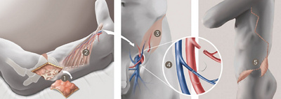 hirslanden-sarkome-1