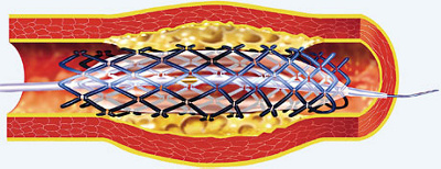 hirslanden-schaufensterkrankheit-2