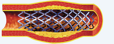 Schaufensterkrankheit