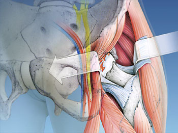 hirslanden-schonender-hueftgelenkersatz-1