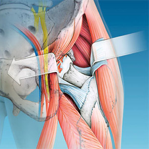 hirslanden-schonungsvollste-zugang-zum-hueftgelenk-2