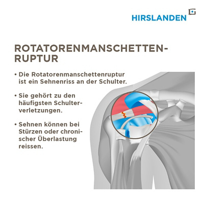 Infografik zum Thema Schultersehnenriss