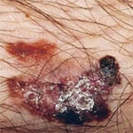 hirslanden-schwarzer-und-weisser-hautkrebs-1