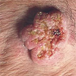 hirslanden-schwarzer-und-weisser-hautkrebs-2