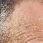 hirslanden-schwarzer-und-weisser-hautkrebs-3