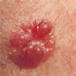 hirslanden-schwarzer-und-weisser-hautkrebs-4