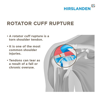Infographic rotator cuff rupture