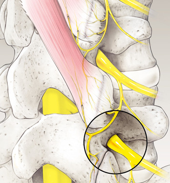 hirslanden-spinalstenose-1