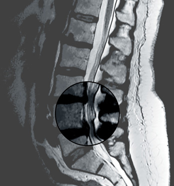 hirslanden-spinalstenose-2