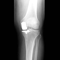 hirslanden-teil-und-miniprothesen-als-alternative-zur-knietotalprothese-1