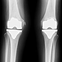 hirslanden-teil-und-miniprothesen-als-alternative-zur-knietotalprothese-2