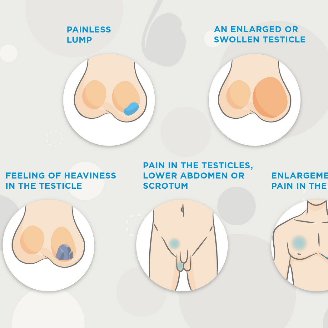 Cancer du testicule : comment réaliser l'autopalpation