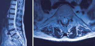 hirslanden-tumore-der-wirbelsaeule-und-des-rueckenmarks-1