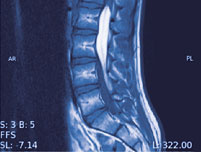 hirslanden-tumore-der-wirbelsaeule-und-des-rueckenmarks-2