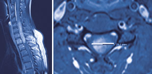 hirslanden-tumore-der-wirbelsaeule-und-des-rueckenmarks-3