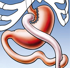 hirslanden-uebergewicht-die-taegliche-qual-1