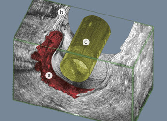 hirslanden-verbesserte-darmdiagnose-mit-3d-1