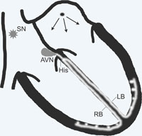 hirslanden-vorhofflimmern-die-haeufigste-herzrythmusstoerung-1