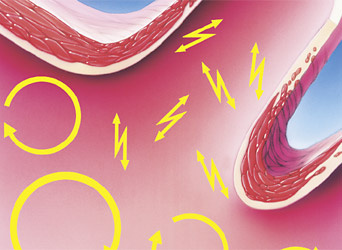 hirslanden-vorhofflimmern-die-haeufigste-herzrythmusstoerung-2