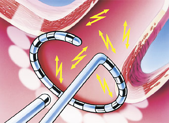 hirslanden-vorhofflimmern-die-haeufigste-herzrythmusstoerung-3