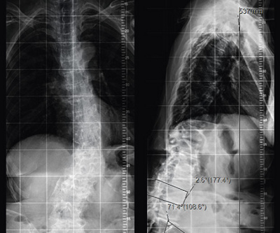 hirslanden-warum-verkruemmt-sich-das-rueckgrat-im-alter-2