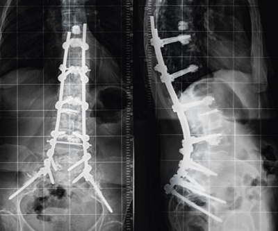 hirslanden-warum-verkruemmt-sich-das-rueckgrat-im-alter-3