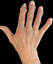 hirslanden-was-ist-eigentlich-rheuma-1