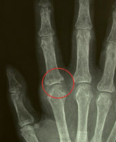 hirslanden-was-ist-eigentlich-rheuma-2