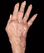 hirslanden-was-ist-eigentlich-rheuma-3