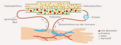 hirslanden-wenn-die-nieren-versagen-1