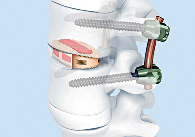 hirslanden-wirbelsaeulenchirurgie-1