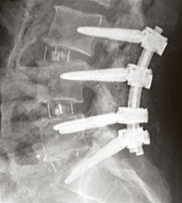 hirslanden-wirbelsaeulenchirurgie-2