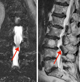 hirslanden-wirbelsaeuleneingriffe-beim-alternden-menschen-1