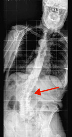 hirslanden-wirbelsaeuleneingriffe-beim-alternden-menschen-2