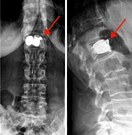hirslanden-wirbelsaeuleneingriffe-beim-alternden-menschen-3