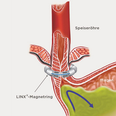 hirslanden-wirkungsvolle-behandlung-bei-saurem-aufstossen-1