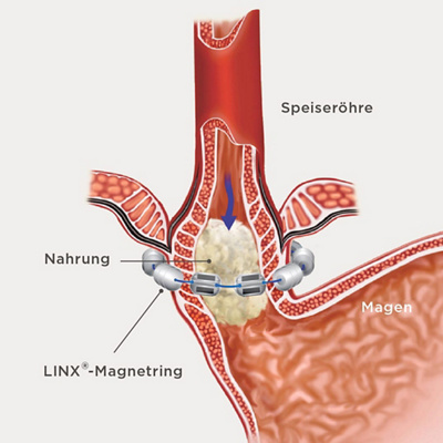 hirslanden-wirkungsvolle-behandlung-bei-saurem-aufstossen-2