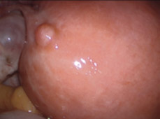 hirslanden-zysten-myom-und-gebaermutterentfernung-1