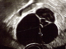 hirslanden-zysten-myom-und-gebaermutterentfernung-2