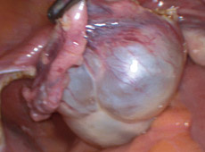 hirslanden-zysten-myom-und-gebaermutterentfernung-3