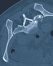 hirslandenn-beckenbruch-im-alter-2