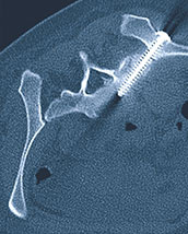 hirslandenn-beckenbruch-im-alter-3