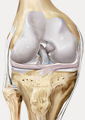 hrislanden-riss-des-vorderen-kreuzbandes-1