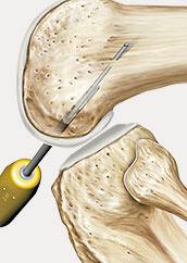 hrislanden-riss-des-vorderen-kreuzbandes-2