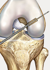 hrislanden-riss-des-vorderen-kreuzbandes-3