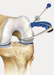 hrislanden-riss-des-vorderen-kreuzbandes-4