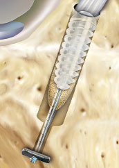 hrislanden-riss-des-vorderen-kreuzbandes-5