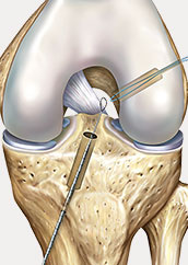 hrislanden-riss-des-vorderen-kreuzbandes-6